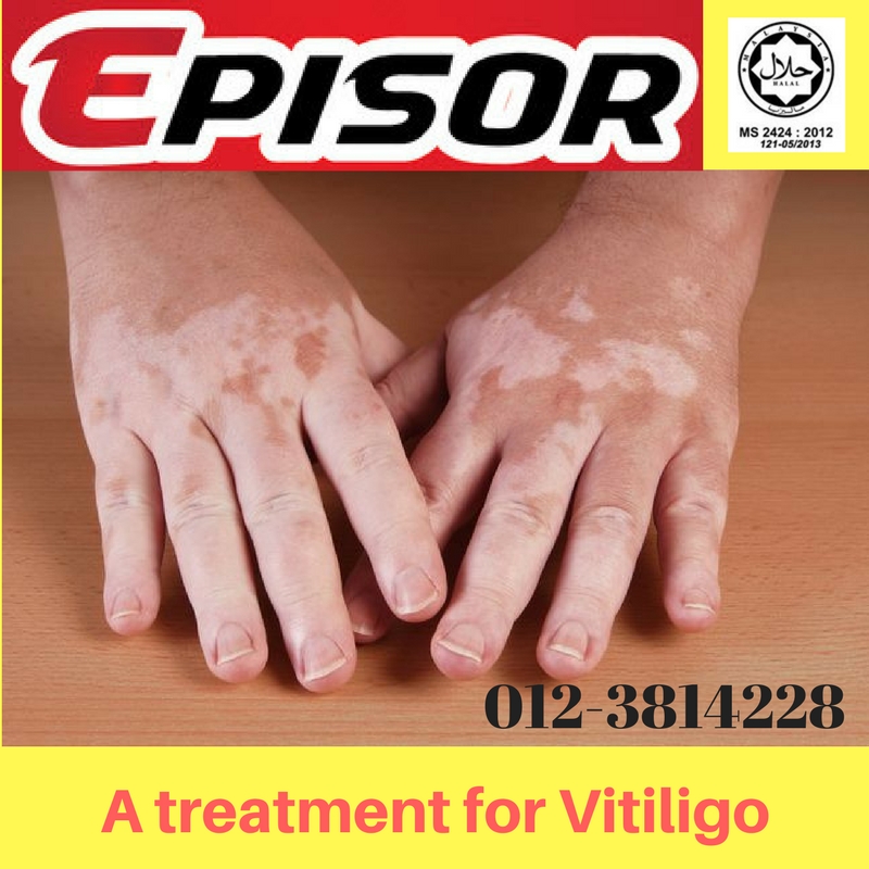 treatment for early vitiligo